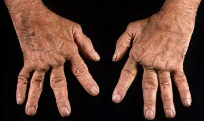 Manos afectadas por artritis reumatoide