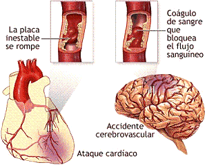 Ataque cardíaco y accidente cerebrovascular por ruptura de la placa